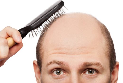 ریزش موی آندروژنیک علل و درمان