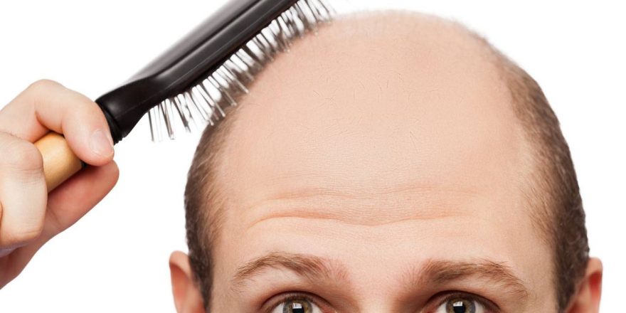 ریزش موی آندروژنیک علل و درمان